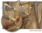 Chirurgia Laparoscopica Colo-Rettale - Marcello Gasparrini MD FACS