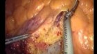 Neoplasie colo-rettali - Marcello Gasparrini MD FACS