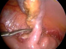 Appendicectomia laparoscopica - Marcello Gasparrini MD FACS